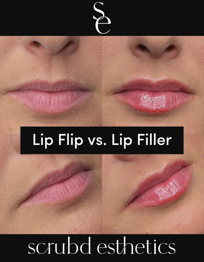 Image of a lip flip vs lip filler in Pittsburgh, PA